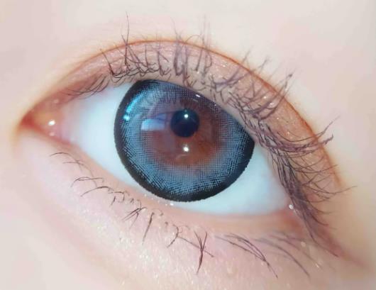 割雙眼皮后多久恢復(fù)自然?雙眼皮疤痕多久消失 割雙眼皮后多久恢復(fù)自然?雙眼皮疤痕多久消失