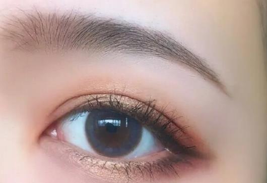 割雙眼皮兩個月了疤痕疙瘩會消除嗎?雙眼皮疤痕周圍很多小疙瘩怎么回事 割雙眼皮兩個月了疤痕疙瘩會消除嗎?雙眼皮疤痕周圍很多小疙瘩怎么回事