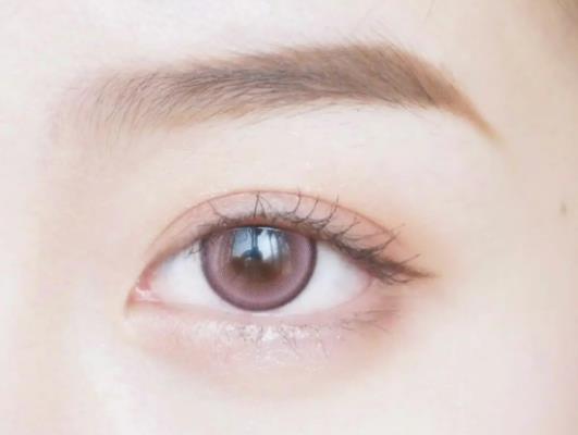 割雙眼皮疤痕疙瘩多久能消失?雙眼皮疤痕周圍很多小疙瘩怎么辦 割雙眼皮疤痕疙瘩多久能消失?雙眼皮疤痕周圍很多小疙瘩怎么辦