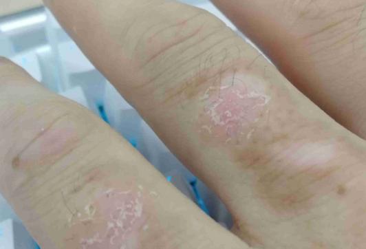 手癬專用藥有哪些 克霉唑乳膏的治療效果好嗎 手癬專用藥有哪些 克霉唑乳膏的治療效果好嗎