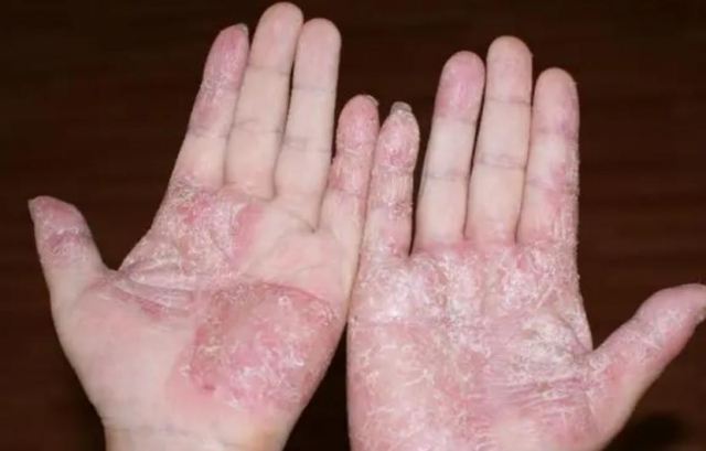 手癬專用藥有哪些 克霉唑乳膏的治療效果好嗎 手癬專用藥有哪些 克霉唑乳膏的治療效果好嗎