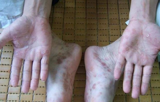 腳氣真菌最怕什么 100℃能殺死腳氣真菌嗎 腳氣真菌最怕什么 100℃能殺死腳氣真菌嗎