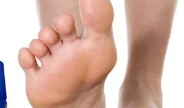手足癬表現有什么癥狀 手足癬有哪些病癥 手足癬表現有什么癥狀 手足癬有哪些病癥