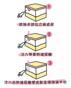 看不到耳朵該選貼發(fā)耳矯正手術(shù)還是玻尿酸?余文林博士告訴你! 看不到耳朵該選貼發(fā)耳矯正手術(shù)還是玻尿酸?余文林博士告訴你!