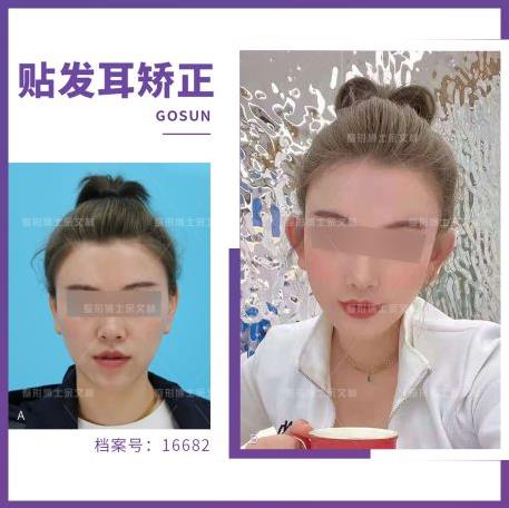 看不到耳朵該選貼發(fā)耳矯正手術(shù)還是玻尿酸?余文林博士告訴你! 看不到耳朵該選貼發(fā)耳矯正手術(shù)還是玻尿酸?余文林博士告訴你!