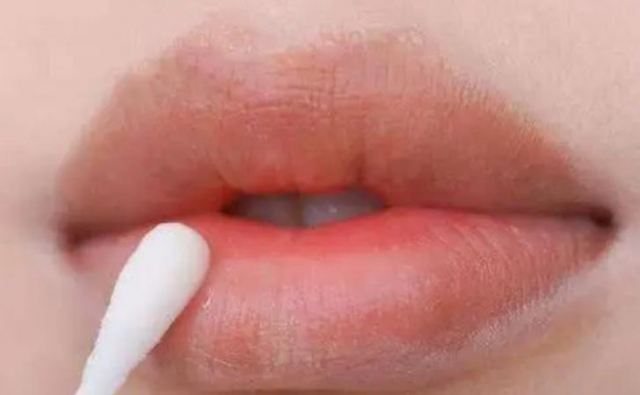 凡士林唇膜天天用會(huì)導(dǎo)致唇炎嗎?慢性唇炎怎么治 凡士林唇膜天天用會(huì)導(dǎo)致唇炎嗎?慢性唇炎怎么治