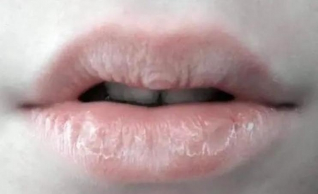 慢性唇炎要多久才會好 慢性唇炎有沒有治好的 慢性唇炎要多久才會好 慢性唇炎有沒有治好的