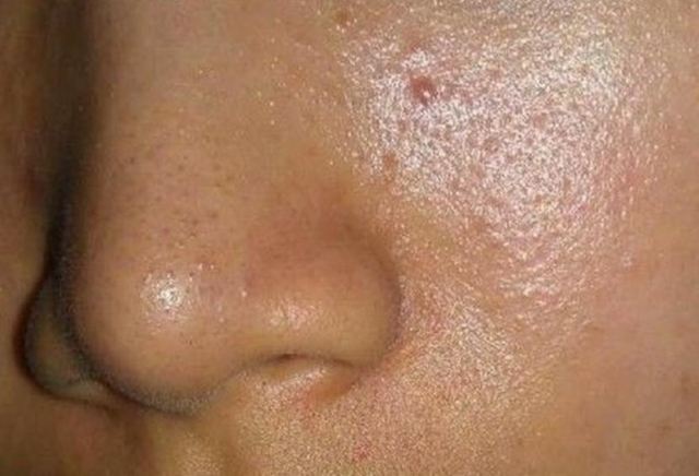 臉上油脂分泌過多時吃什么調理 臉上出油吃什么維生素 臉上油脂分泌過多時吃什么調理 臉上出油吃什么維生素