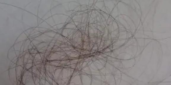 脫發(fā)吃維生素B2還是B6 掉頭發(fā)看皮膚科嗎 脫發(fā)吃維生素B2還是B6 掉頭發(fā)看皮膚科嗎